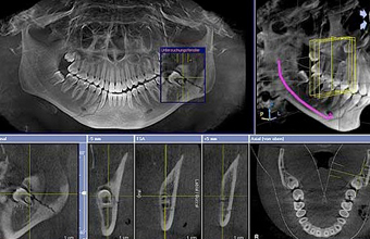 歯科用CTによる正確な精密な診査診断