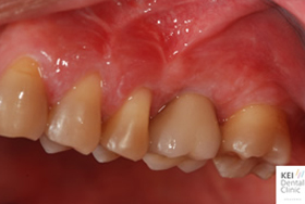 （40歳代男性）歯が原因の蓄膿症で膿みが出てくる