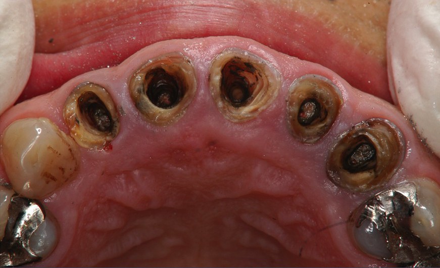 クラウン（被せ物）を外してみると…虫歯が歯の中で進行している