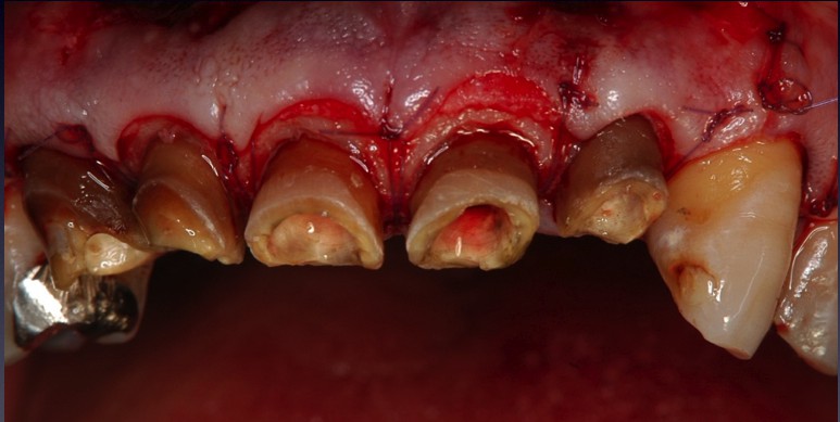 クラウン（被せ物）を外してみると…虫歯が歯の中で進行している