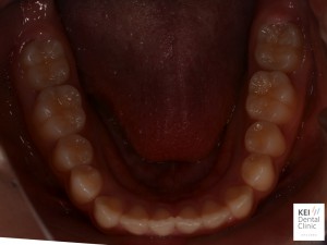 正常な歯列、治療の必要な歯列とは？