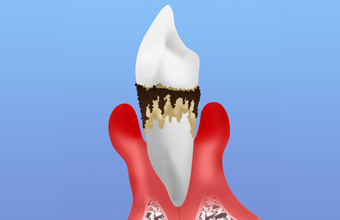 成人の約8割が歯周病予備軍ということをご存知ですか？