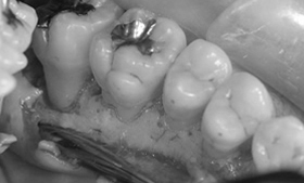 歯周外科を利用した歯周治療