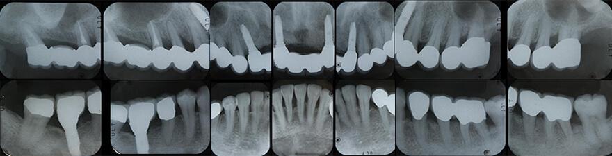 【見出し】歯周外科を行い骨を造った例